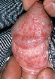 secreción del pene debido a aftas